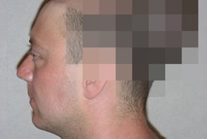 Мужчине надули голову, чтобы избавить от лысины