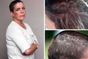 Домохозяйка осталась лысой после наращивания волос суперклеем