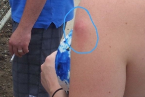 Девушку укусило насекомое