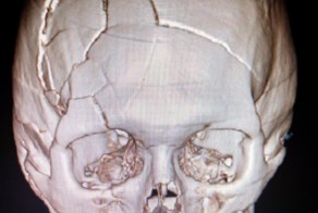 Страшный перелом черепа