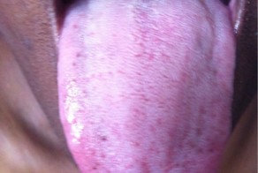 Парень обжог своя язык