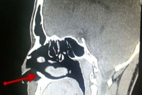 Стоматологи вырвали из носа пациента зуб