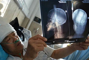 Упавший с балкона нож, воткнулся мужчине в голову