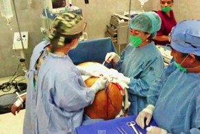 Хирурги удалили женщине огромную опухоль