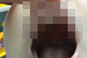 Лишний зуб у мальчика