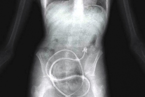 Необычные вещи, найденные в человеческом желудке