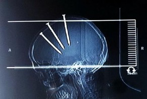 Дедушка забил себе в голову три 10-сантиметровых гвоздя и выжил