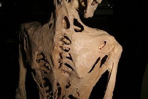 Реальные болезни, которые как-будто бы взяты из фильма ужасов