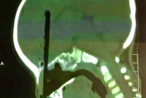 Палочка для еды в голове у ребенка