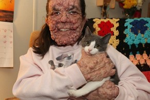 Заболевание превратило американку в чудовище