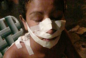 Сестры изуродовали девушку, позавидовав ее красоте