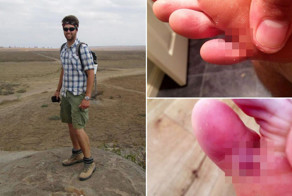 Студент подцепил в Африке песчаных блох