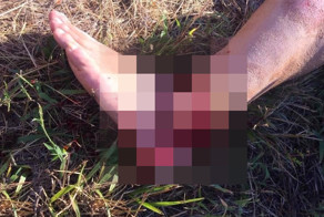 Перелом лодыжки