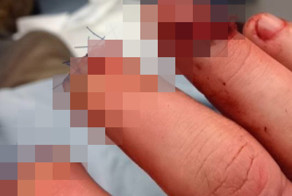 Если сильно грызть ногти на руках