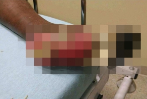 Смерть от заражения