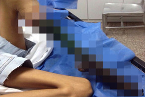 Из-за укуса змеи у девочки отсохла нога