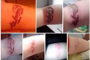 К чему приводит самостоятельное удаление татуировок