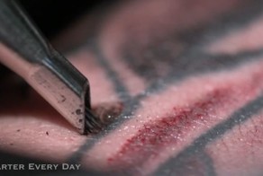 Удаление татуировки лазером