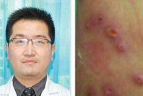 Врачи достали из-под кожи туриста два десятка живых личинок