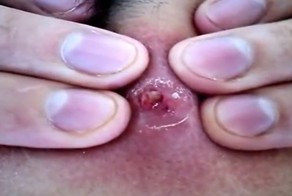 Выдавливание прыща, созревавшего на шее мужчины 20 лет