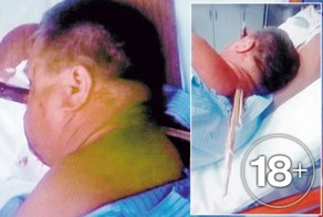 С 38-сантиметровой палкой в голове 