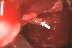 Удаление пули из глазницы