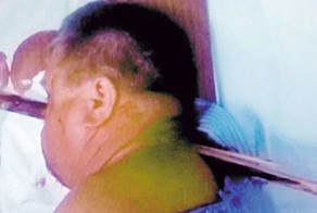 В Польше мужчина пришел в больницу с деревянной рейкой в голове