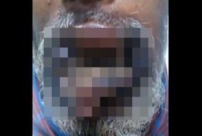 Супергерпес