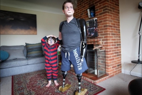 Мужчина, потерявший четыре конечности