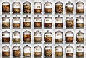 Коллекция мозгов пациентов психиатрической больницы