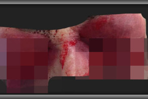 Шизофреничка выдернула себе глаза