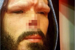 Парень отрезал себе кусок носа