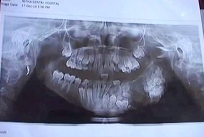 Семилетнему мальчику удалили 80 зубов