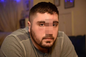 Боксеру откусили нос в пьяной драке