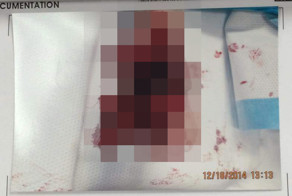 Выстрел в ногу из дробовика