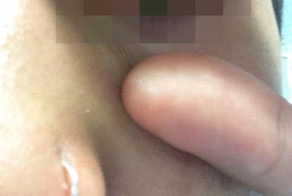 Аллергическая реакция на лекартво