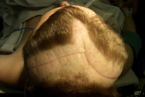 Восстановление черепа