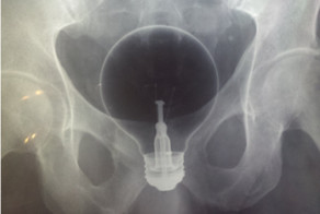 Удивительные рентгенограммы: инородные предметы в человеческом теле