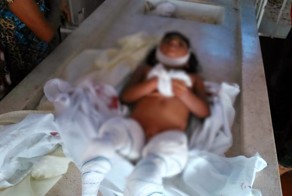 Пираньи обглодали девочке ноги