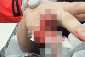 Палец с кольцом застрял в заборе