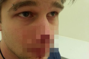 Собака откусила парню кусок носа