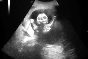 Как выглядят дети в утробе матери на экранах аппаратов УЗИ