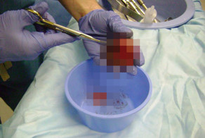 Опухоль с фрагментами неродившегося близнеца