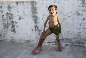 Индийский мальчик с огромной ногой 