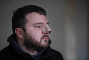 Мужик проснулся без носа после пьянки