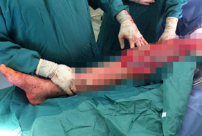 Протезирование бедренной кости и коленного сустава