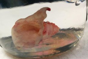 Операция по удалению пупка