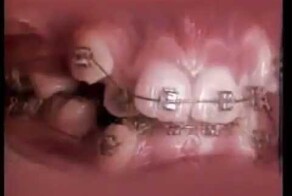 Брекеты: 18 месяцев за 30 секунд