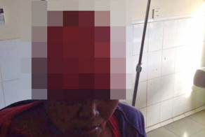 Как лишиться кожи на голове