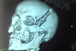 Человек с ножом в голове